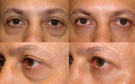 Natural Results To Eyelid Bags And Dark Circles In Men Cosmetic