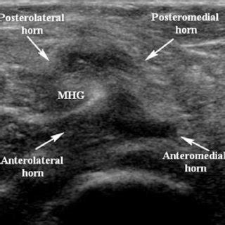 A Longitudinal Sonogram Shows A Thick Walled Baker S Cyst With