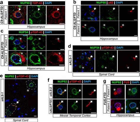 FG NUPs Colocalize With TDP 43 Proteinopathy In ALS FTLD NUP98 NUP54