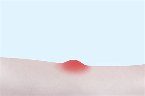 Itchy Red Spot Bump On The Skin Stock Photo - Download Image Now ...