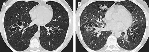 Volumetric Expiratory Hrct Of The Lung Clinical Applications