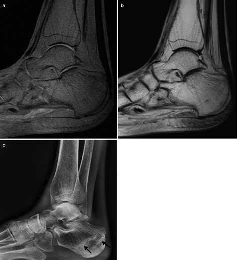 Fig 123 Serous Atrophy Of Bone Marrow Musculoskeletal