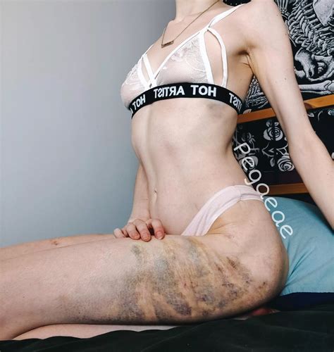 I Love My Bruises F Nudes BDSMgonewild NUDE PICS ORG