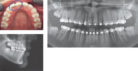 Concepts Of Retention Pocket Dentistry