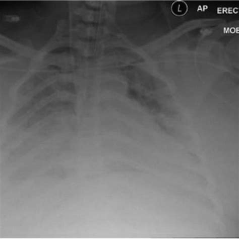 Mobile Anteroposterior Ap Chest Radiograph Showing Widespread