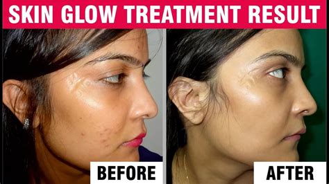 Best Hydra Facial Treatments For Glowing Skin Sakhiya Skin Clinic