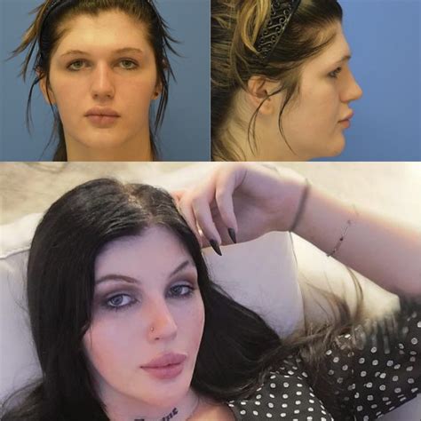 Transgender Surgery Before And After Photos