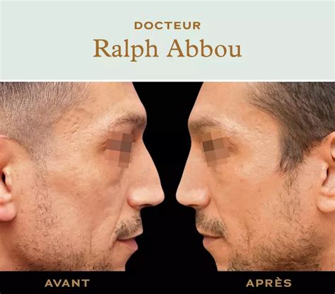 Rhinoplastie naturelle à Paris Dr Ralph ABBOU