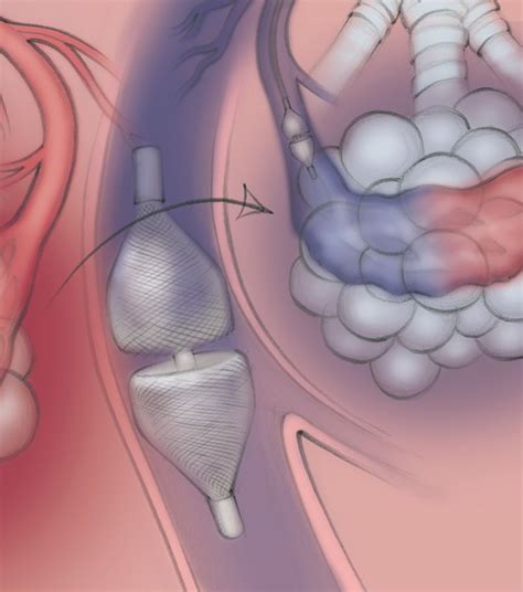 Pulmonary Avm Embolization — Learn Ir