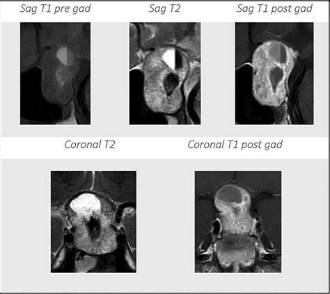 Do We Need Gadolinium-Based Contrast Agents for Routine MRI