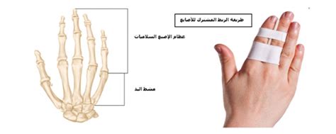 كيفية العناية بطفلك المصاب بكسر في الإصبع Sidra Medicine