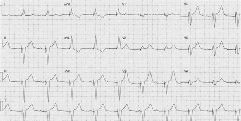 Dr Smith S Ecg Blog Paced Rhythm Are There Hyperacute T Waves See