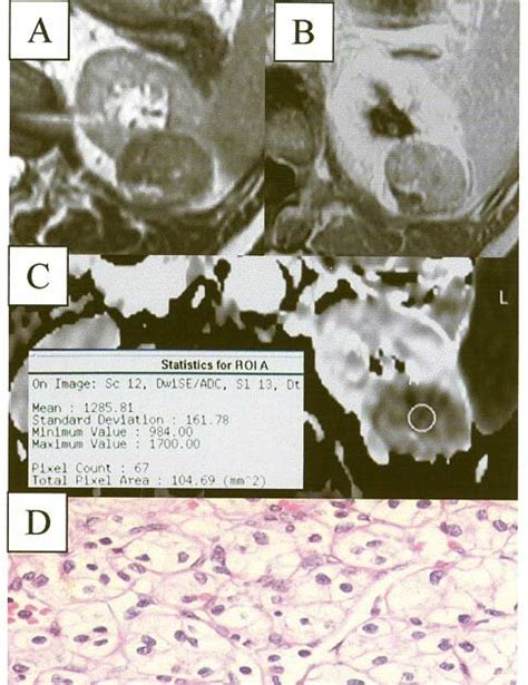 Multilocular Cystic Renal Cell Carcinoma Axial Acquisition Tse