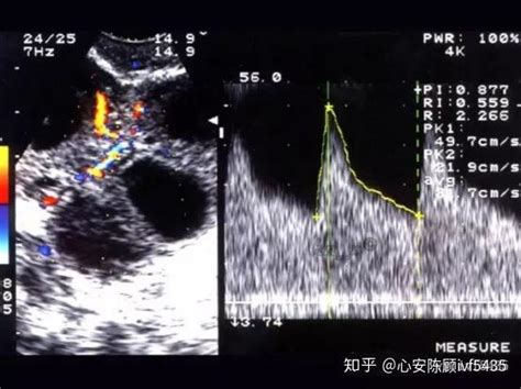 一分钟全面了解卵巢过度刺激综合症 知乎