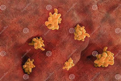 Entamoeba Histolytica Invading Intestine Stock Illustration Illustration Of Medical Bacteria