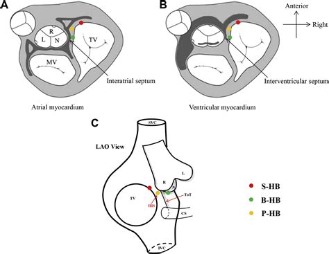 Accurate Localization And Catheter Ablation Of Superoparaseptal