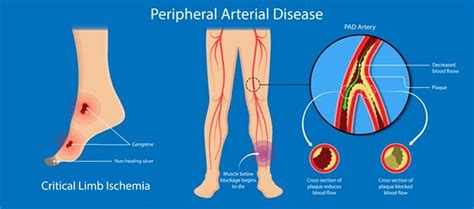 Peripheral Artery Disease Pad And Diabetic Foot Ulcer Treatment In Florida