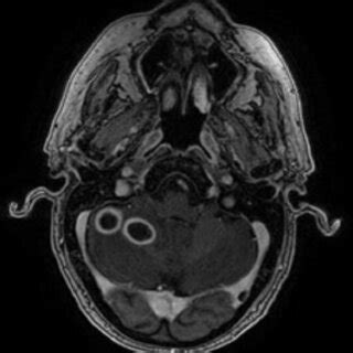 MRI brain with contrast, T1-weighted image showing 2.0 cm and 1.7 cm... | Download Scientific ...