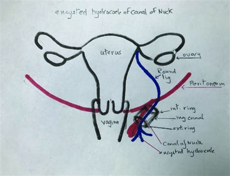 Hydrocoele Of Canal Of Nuck Diagram Demonstrating Patent Processus