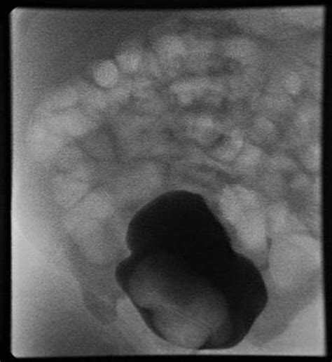 Ureterocele - wikidoc