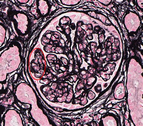 Membranoproliferative Glomerulonephritis Em