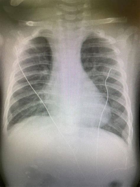 Pneumonia In Children