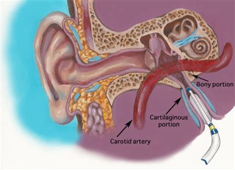 Eustachian Tube Dysfunction