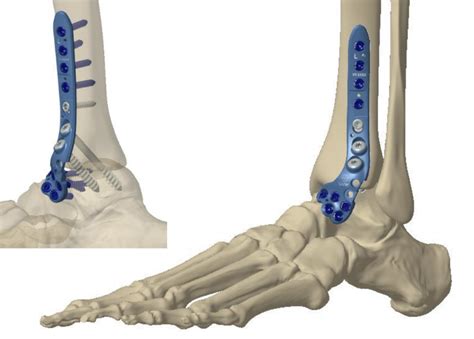 Arthrose oberes Sprunggelenk ORTHO PEDE Zentrum für Fuß und