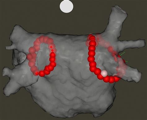 Electroanatomical Map Of The Left Atrium After Pulmonary Vein Isolation