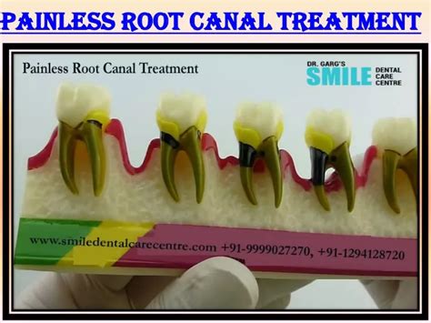 Ppt Painless Root Canal Treatment In Faridabad Delhi Ncr Powerpoint