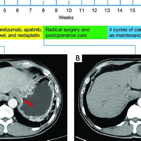 The timeline of the whole treatment and the CT scans. (A) An initial... | Download Scientific ...