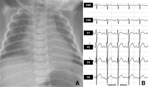 Hypoplastic Left Heart Syndrome With Left Ventricular Myocardial Sinusoids Echocardiographic