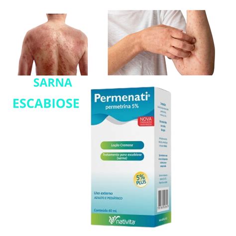 Permenati 5 Permetrina Loção Para Sarna Escabiose Coceira No Corpo