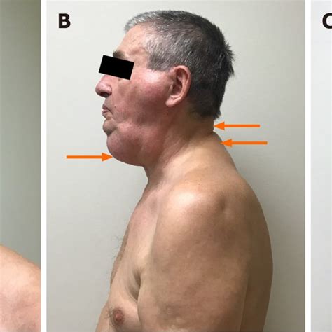 Classification Of Multiple Symmetric Lipomatosis According To Fatty