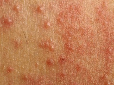 Malassezia Folliculitis