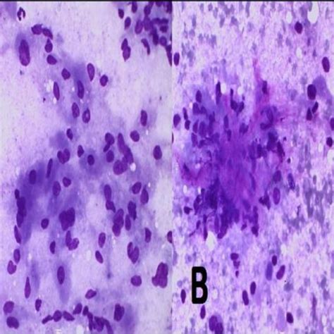 A Fnac Smears Showing Few Clusters Of Cells Having Abundant Granular Download Scientific