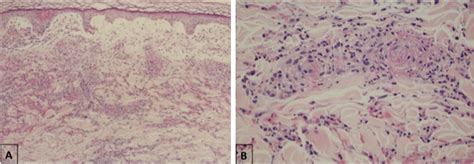 Scielo Brasil Skin Manifestations Associated With Covid 19 Skin