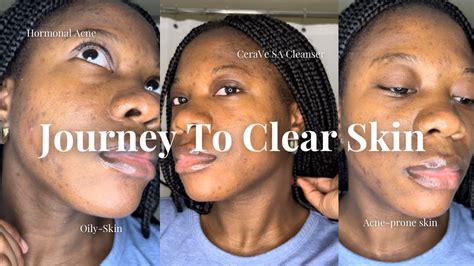 My Easy 5 Step Skincare Routine For Acne Prone Skin Youtube