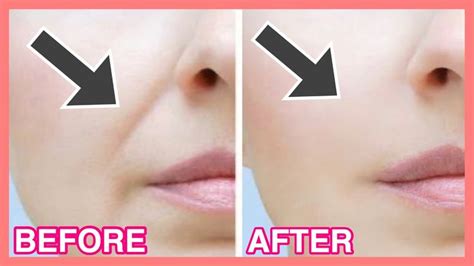 Get Rid Of Smile Lines With Facial Exercises