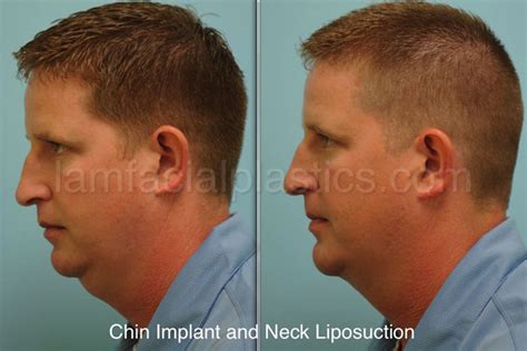 Neck Liposuction Dallas, Cosmetic Facial Surgery Procedures Plano, TX