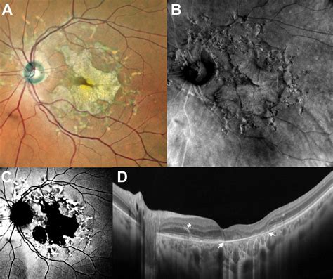 Multimodal Imaging Of Fundus Flecks And Macular Atrophy In Stargardt Disease Ophthalmology