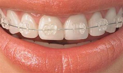 Şeffaf Diş Teli Nedir Konya Dentium Ağız ve Diş Sağlığı Polikliniği