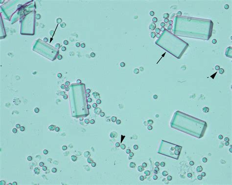 Urine Crystals Eclinpath