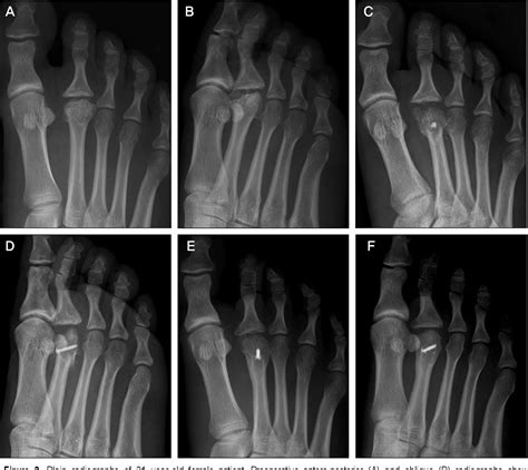 Pdf Weil Osteotomy For Freibergs Disease Semantic Scholar