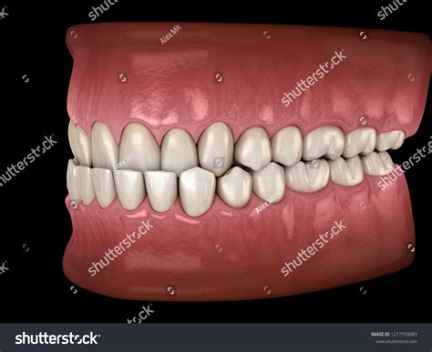 Underbite Dental Occlusion Malocclusion Teeth Medically Stock