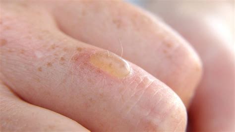 How Do You Treat A Burn Blister Alhydran Co Uk