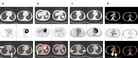 Exhaled Mycobacterium Tuberculosis Output And Detection Of Subclinical