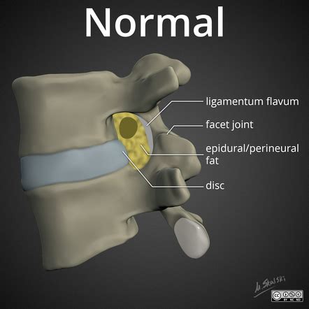 Foraminal Stenosis MRI