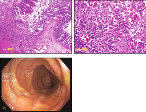 Colon Mucosa With Ulceration And Inflammatory Cellular Infiltrate Download Scientific Diagram