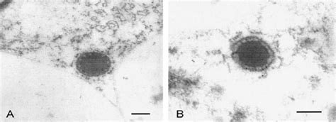 Immunogold Double Labeling Of Protein Accretions In Thin Sections Of